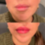 Lip Filler