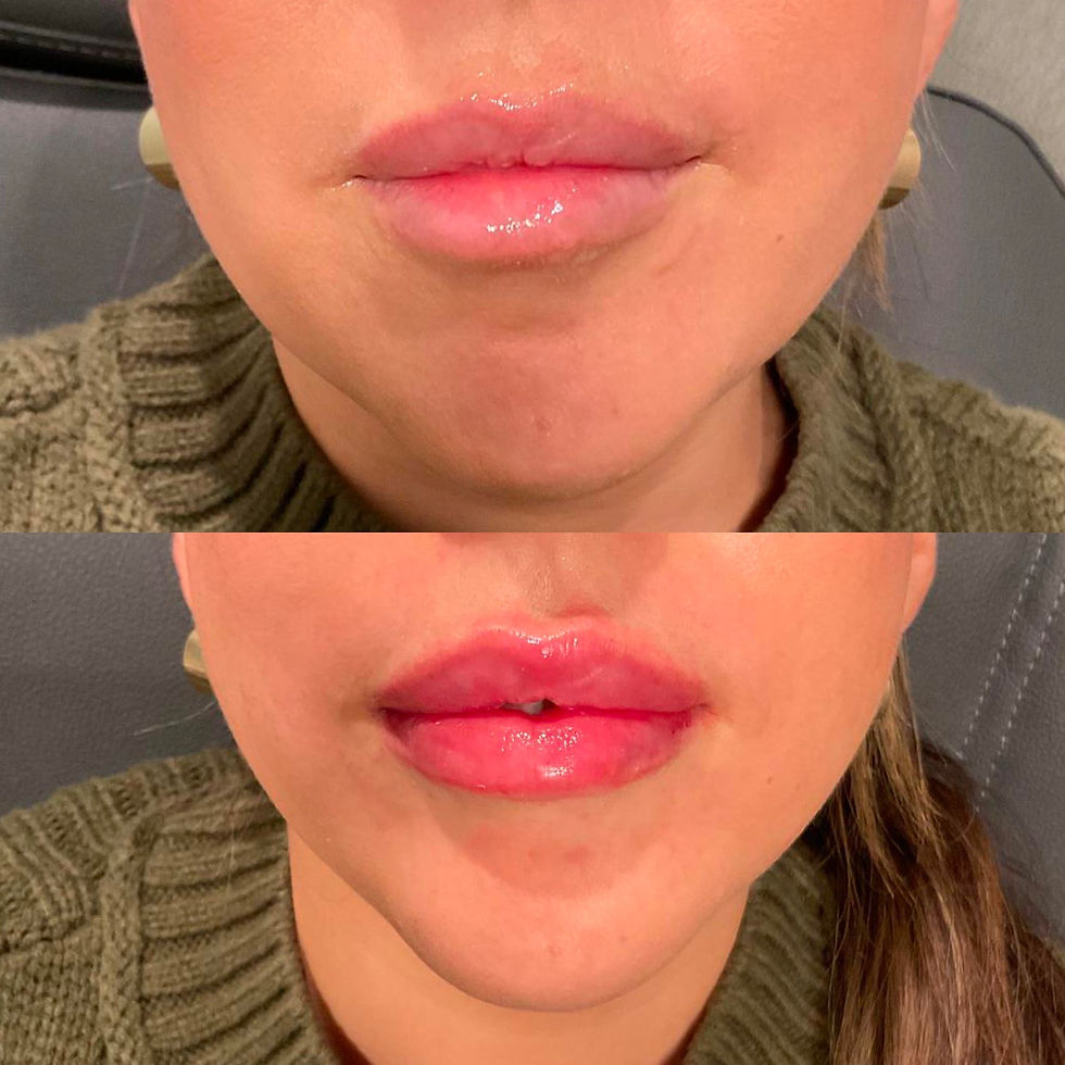 Lip Filler