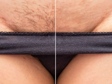 Queimadura na virilha rendem danos morais à empresa de depilação a laser