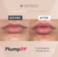 V-ST Lip Plump - 4 Sessions