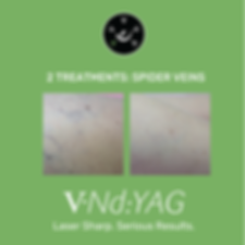 Laser Nd:YAG Veins Removal - Small Area