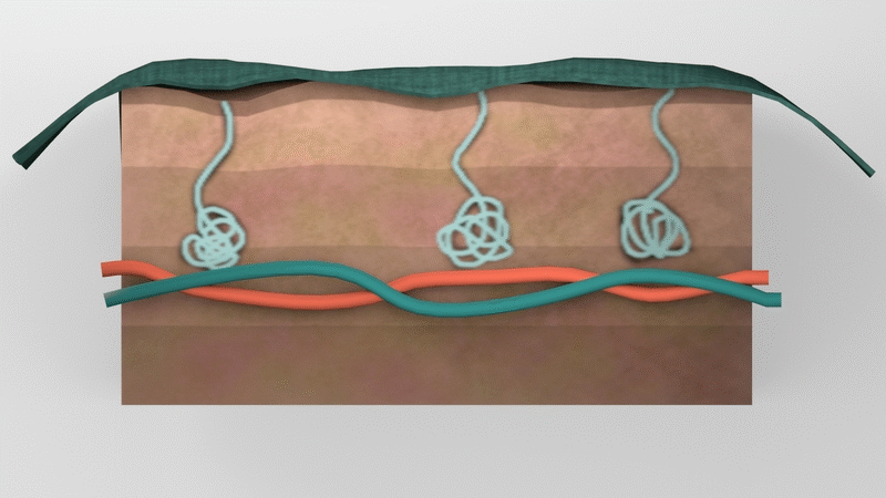 Iontophoresis.gif