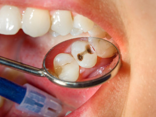 How Can I Prevent Cavities?