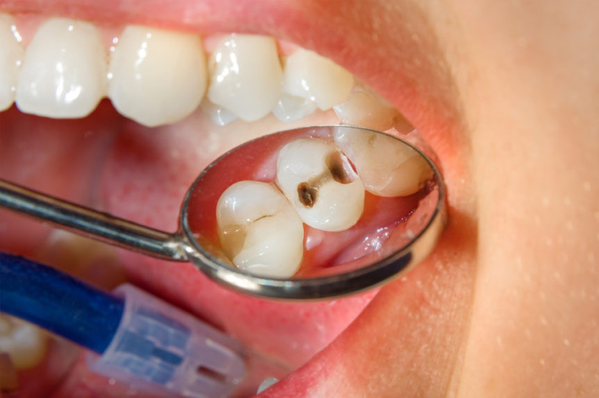 dentist checking for Cavities