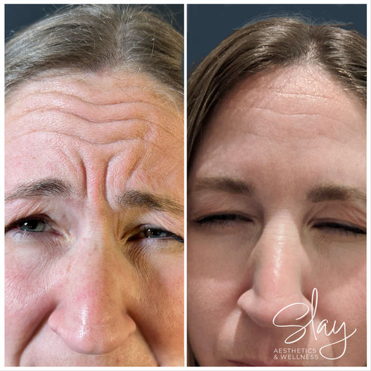 Botox, Jeuveau, Dysport, Xeomin, Before and After 4