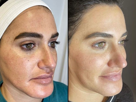 Skin Resurfacing With Opus Plasma