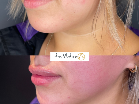 What’s the difference between Juvederm and Restylane?