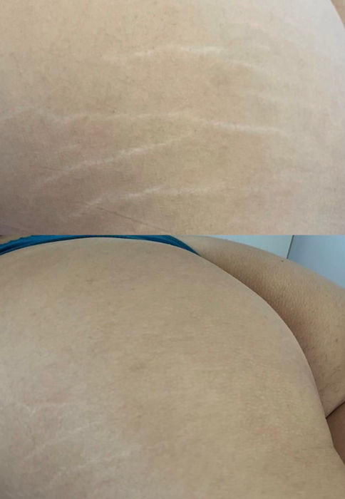 Before and after stretch mark treatment results at BeBeauty Auckland showing visible skin texture improvement.