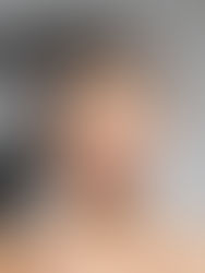 Botulinum Toxin (Dysport®) in Auckland: Treatment Overview & What to Expect at Clinic4O2