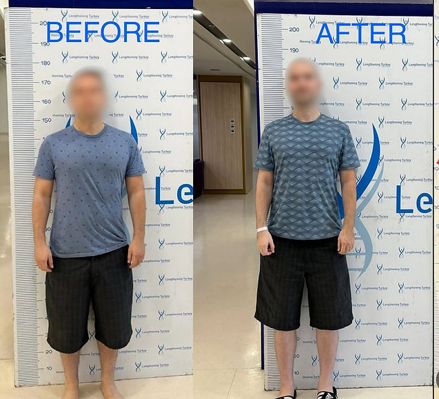 Leg lengthening in turkey before after.jpg