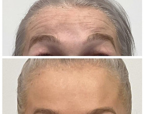 karli daxxify forehead orlando med spa