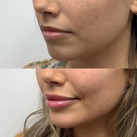 best lip filler injections orlando