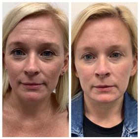 neurotoxin for forehead lines near me 