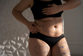 Tummy Tuck 101