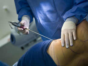 Liposuction. What is it?