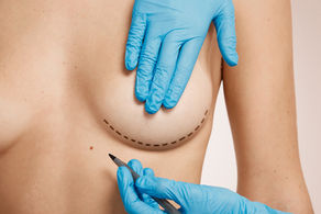 Breast Reduction: The ins and outs.