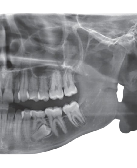 teeth and impacted premolar