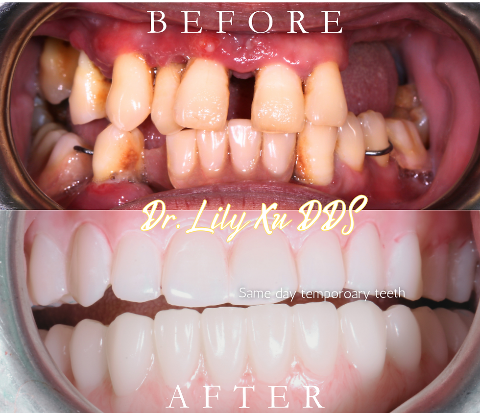 Immediate fixed prosthesis