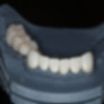 same day denture