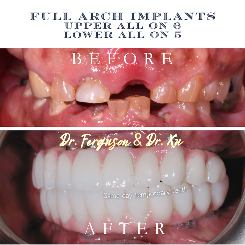 full arch implants, upper all on 6, lower all on 5