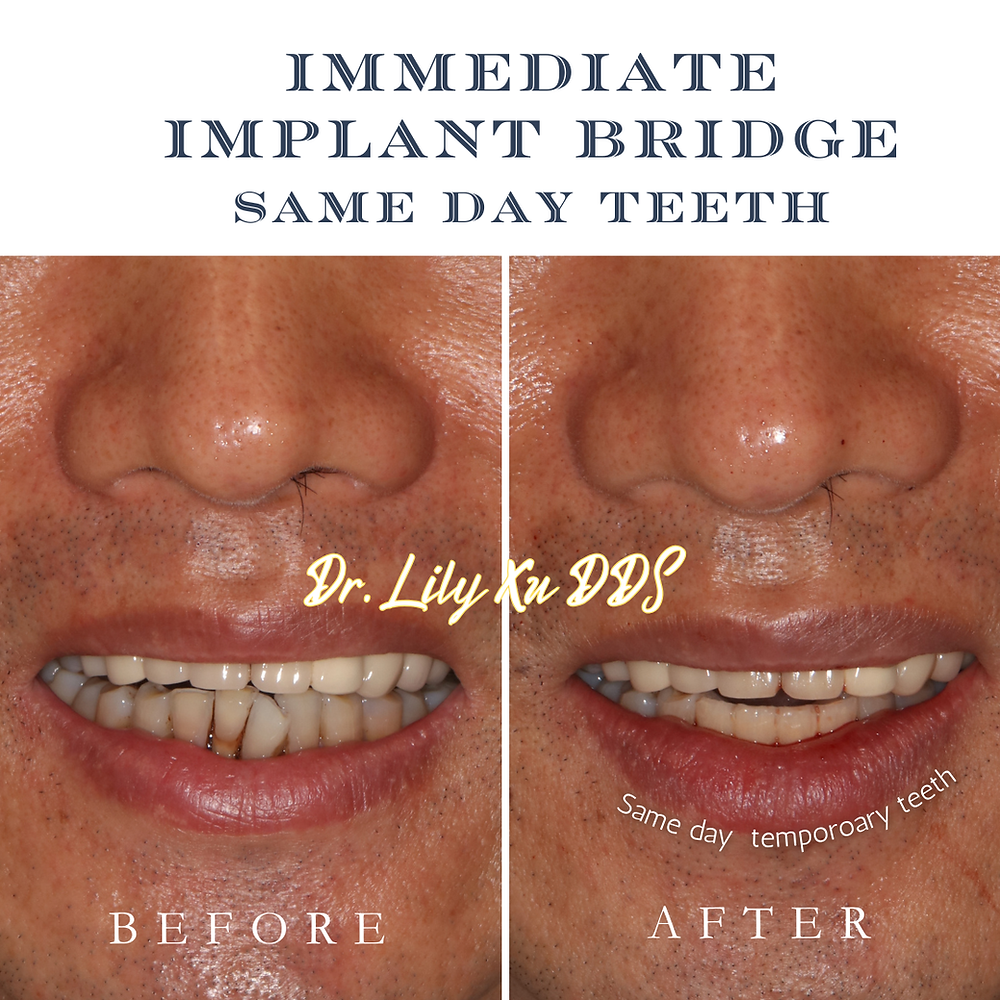 Immediate implant bridge same day teeth