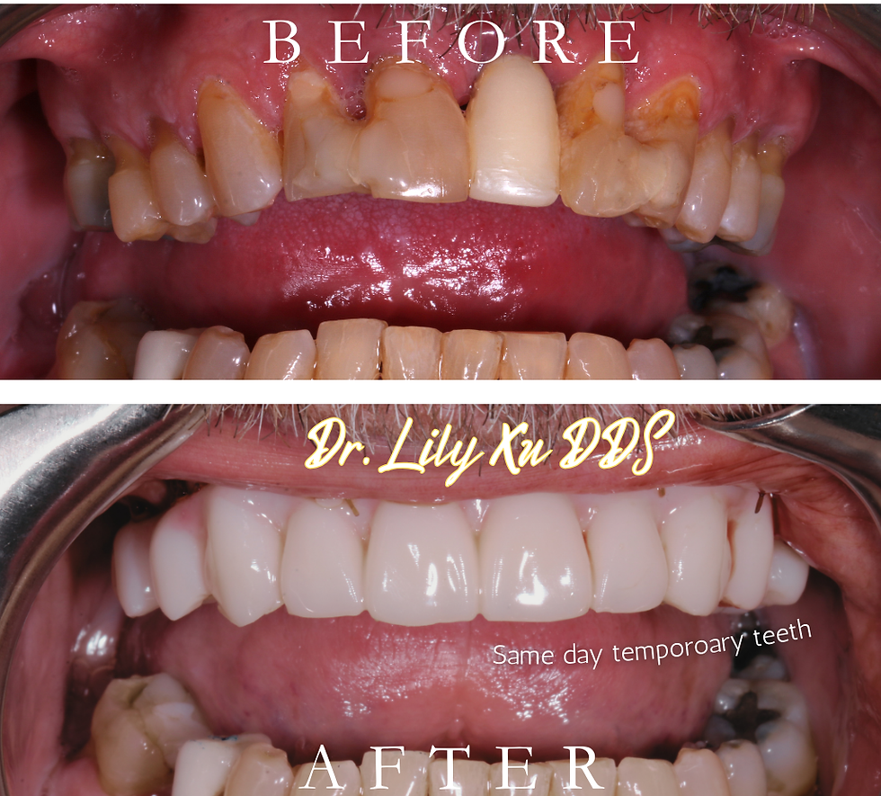 Esthetic smile design before and after