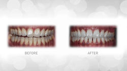 tooth whitening 2