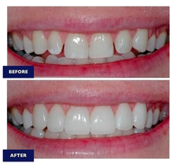 Dental Veneers