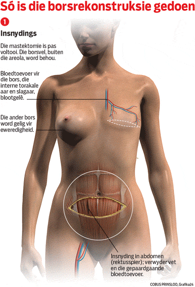 Breast reconstruction