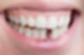 dental-implants.jpeg