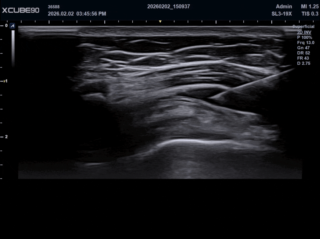 회전근개 (2) (1).gif
