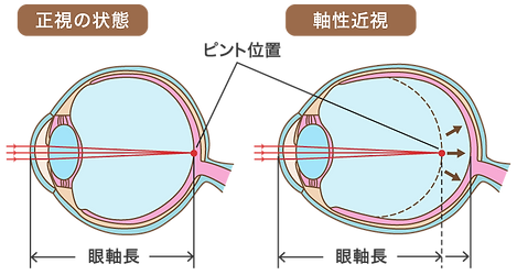 元木町眼科・小田栄院 近視