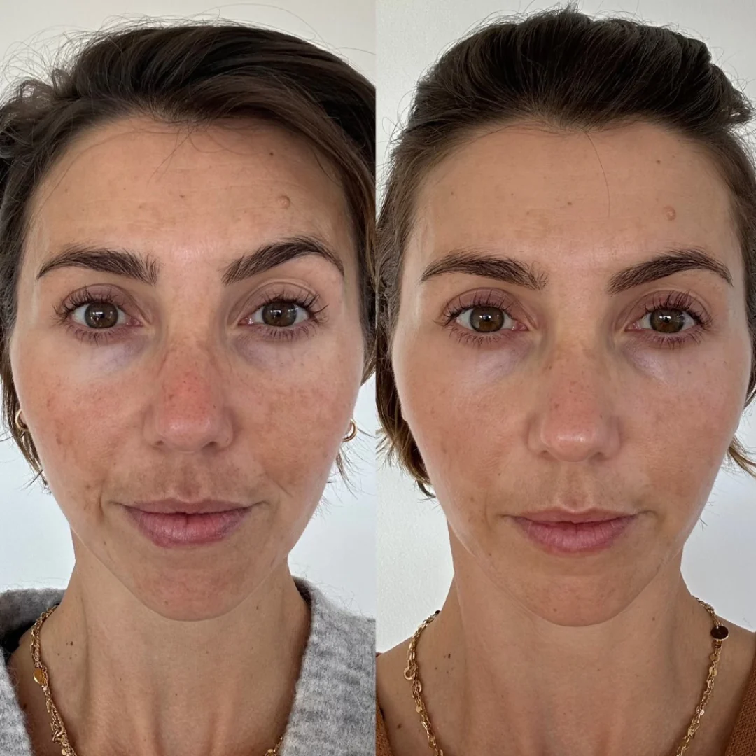 microneedling transformation