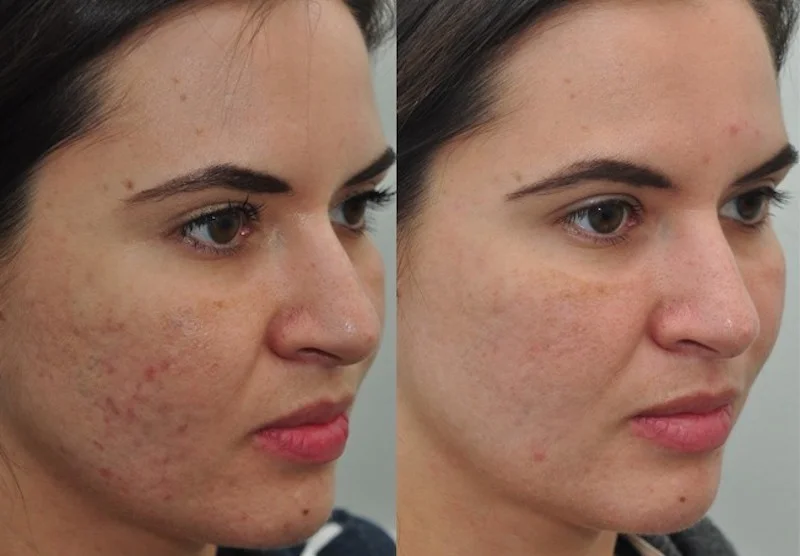 microneedling transformation