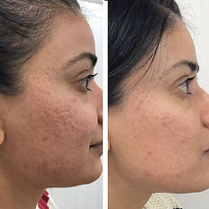 microneedling transformation