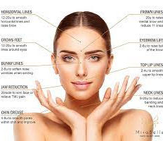 Points to treat with dermal Fillers