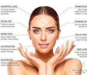 Points to treat with dermal Fillers