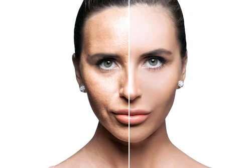 micro needling transformation