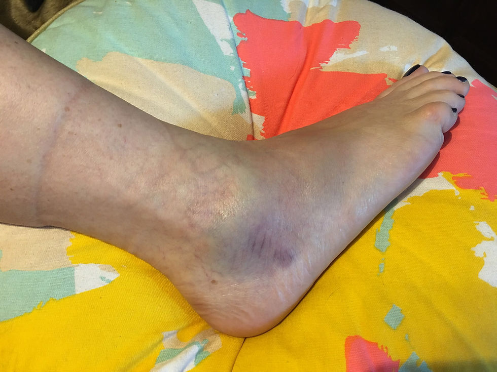 Picture of injured foot, large bruise on ankle