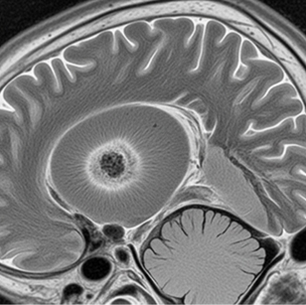 A sagittal T2-weighted MRI scan of a brain showing a large, round, fluid-filled cyst with a concentric ring pattern (bullseye appearance) in the cerebrum.