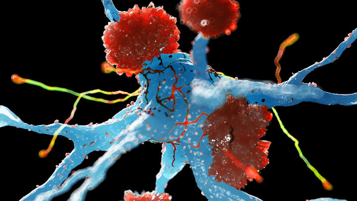 This is a 3D medical illustration showing a neuron (blue) being attacked by red, fuzzy amyloid-beta plaques (or toxic aggregates) in a black background, representing the cellular damage in Alzheimer's disease.