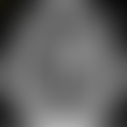 A medical MRI scan of a human brain displays a large, circular white mass labeled "Glioblastoma." Thin white lines radiate outward from the center of the growth within the brain tissue.