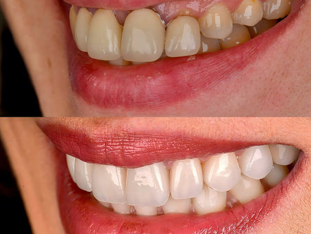 Implantes Dentales: Durabilidad y Coste en Madrid