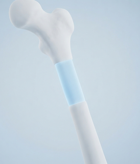 Vital for orthopedic surgeries, spinal fusions, and limb-salvage procedures, helping to repair fractures, replace bone lost to trauma or cancer, and prevent amputations.