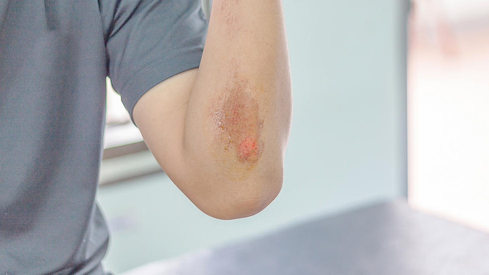 Wound Healing