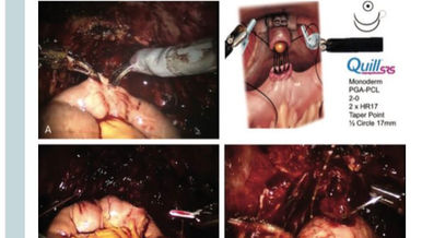 Nuovo capitolo di libro su libro New Technologies and Techniques in Minimally invasive Urologic Surg