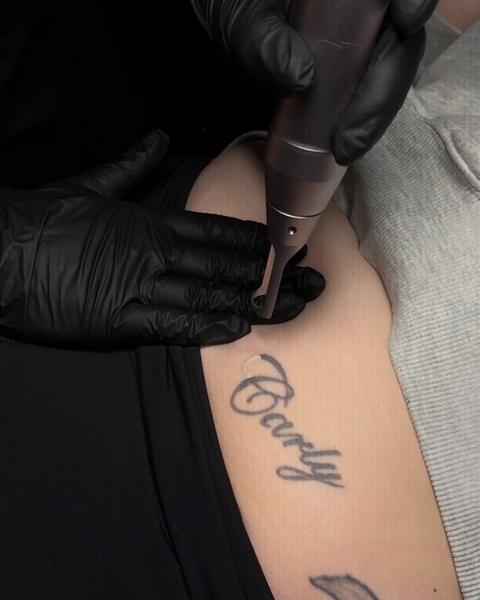 Laser tattoo removal being performed on a client’s arm at MC Laser & Beauty.