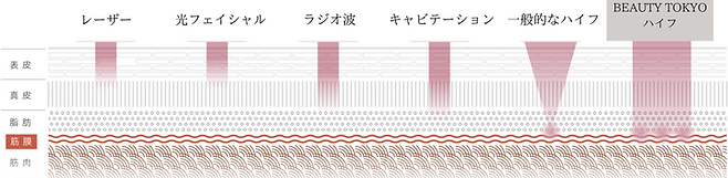 HIFU（他の機械との違い）