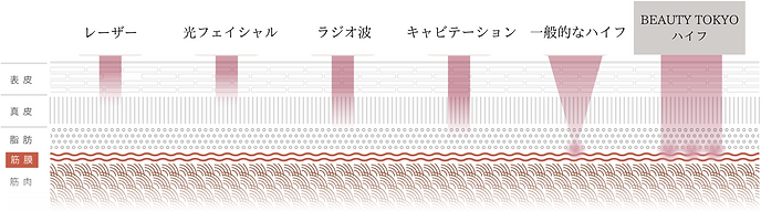 HIFU(他の機械との違い)