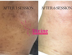 LASER HAIR REMOVAL CHIN BEFORE AFTER| DIVINE BRAZILIAN WAX & SPA SNELLVILLE,GA